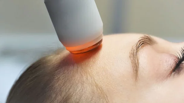Radiofrequenz-Microneedling Behandlung im Gesicht.