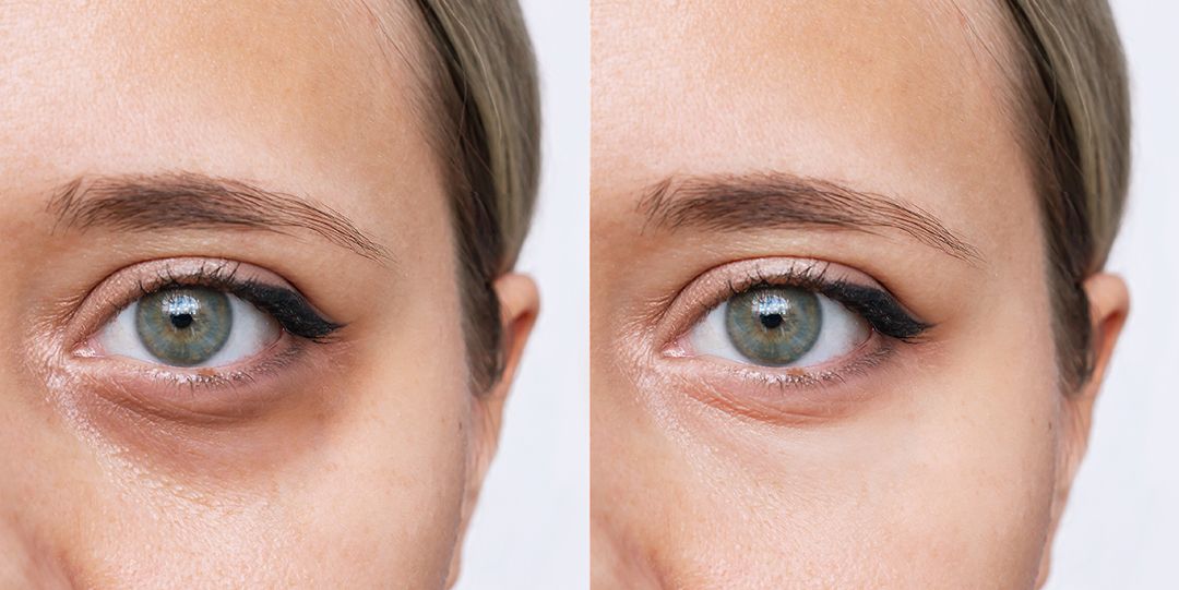 Vorher-Nachher-Bild der Augenpartie – Behandlung gegen Augenringe und glattere Haut.