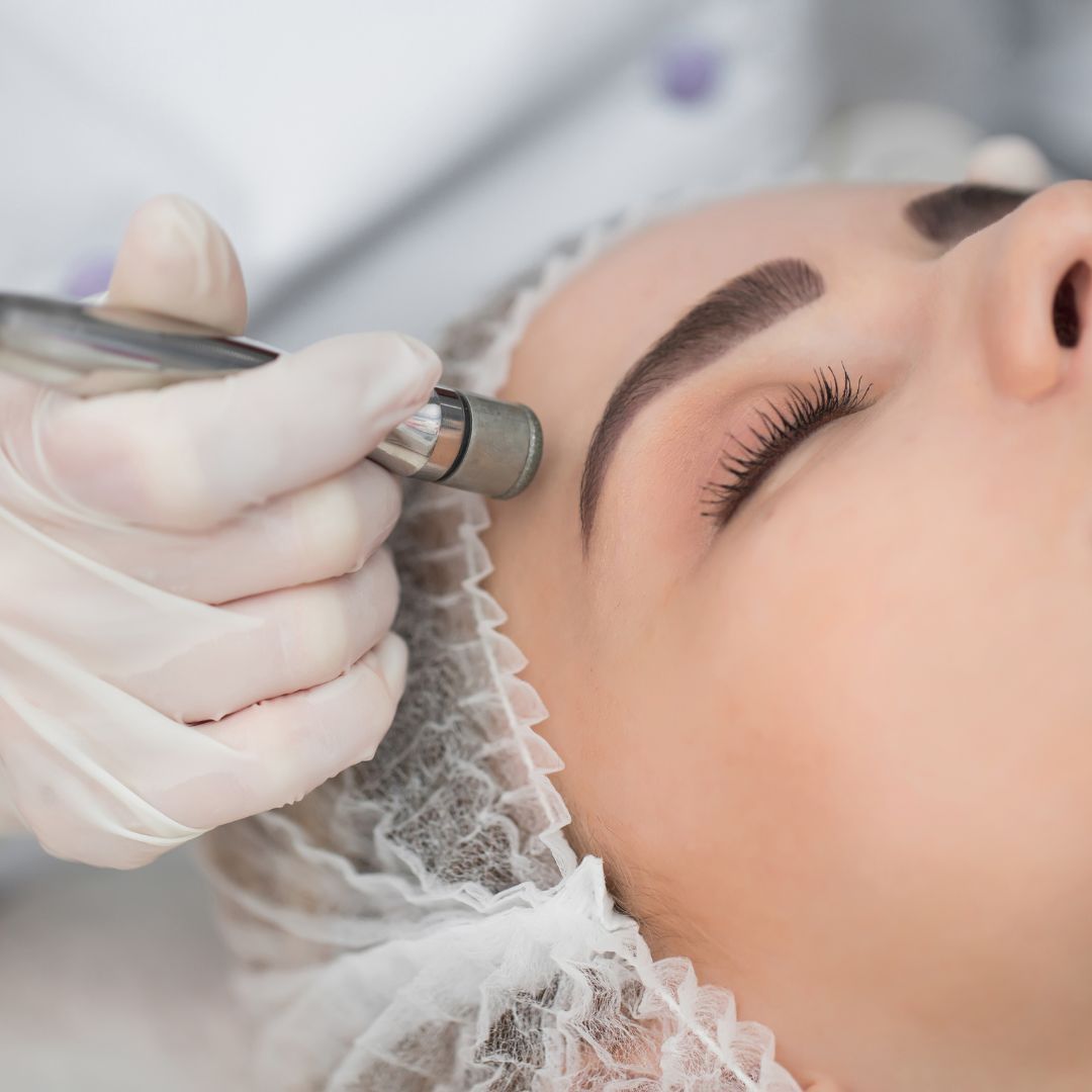 Diamant-Mikrodermabrasion im Gesicht – sanftes Peeling für strahlende Haut.