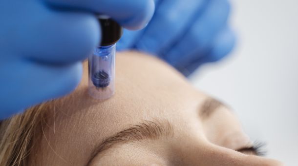Microneedling Behandlung im Gesicht – Hautverjüngung mit feinen Nadeln.