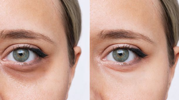 Vorher-Nachher-Bild der Augenpartie – Behandlung gegen Augenringe und glattere Haut.